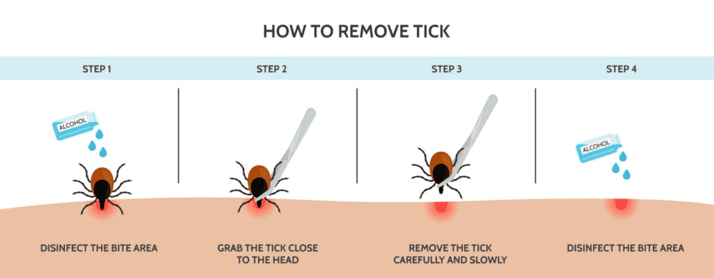 The steps of how a tick gets embedded into a person's skin.