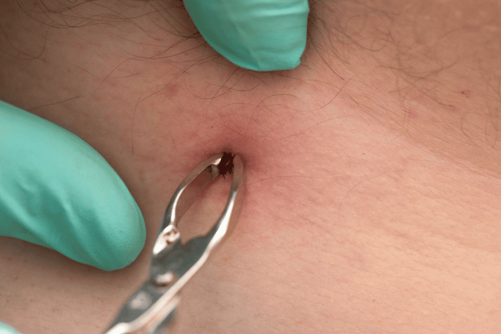 safe removal, using tweezer, of a tick embedded into a person's skin